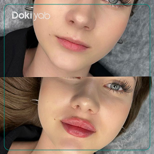 بررسی نحوه تزریق ژل لب قلوه ای