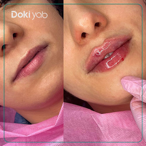 مراقبتهای بعد از تزریق ژل لب قلوه ای