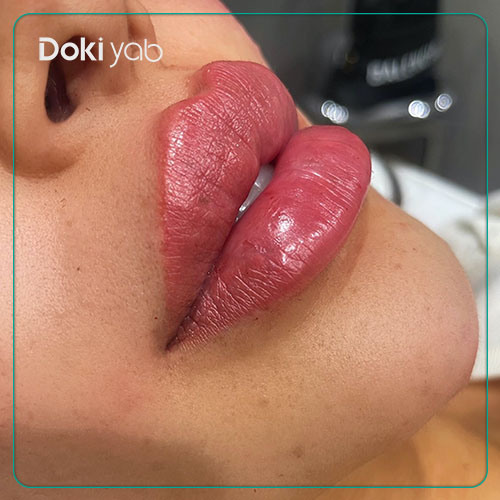 بررسی کاندیدای مناسب تزریق ژل لب قلوهای