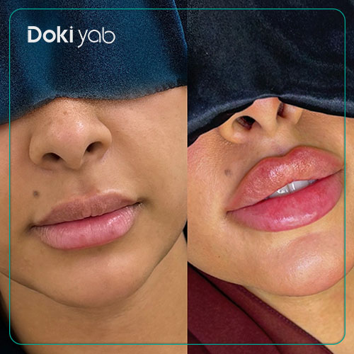 بررسی مزایای تزریق ژل لب قلوهای