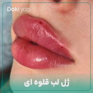 ژل لب قلوه ای چیست؟ عکس لب قلوه ای + هزینه و مراقبت‌ها