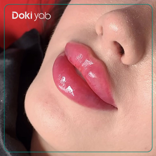 عکس نمونه تزریق فیلر لب قلوهای