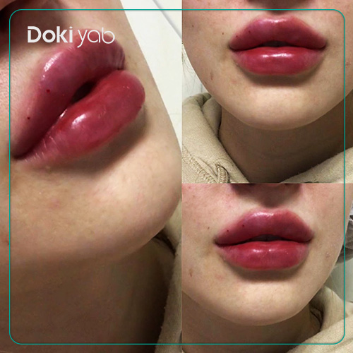 نمونه تزریق فیلر لب به سبک قلوهای