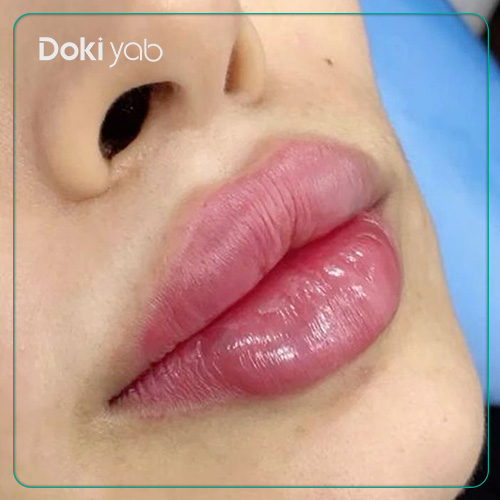 عکس فیلر لب قلوهای