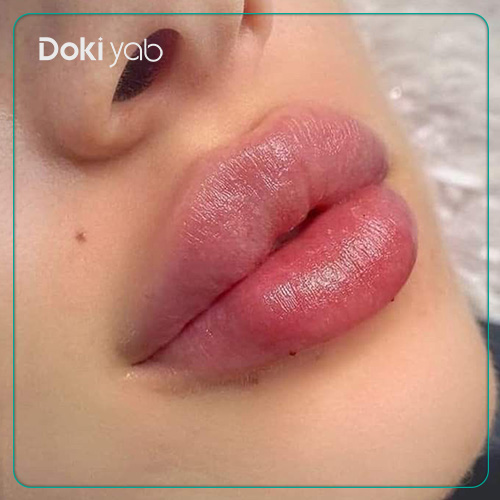 عکس تزریق ژل لب قلوهای