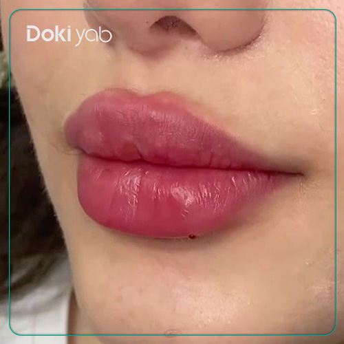 عکس نمونه تزریق ژل لب قلوهای