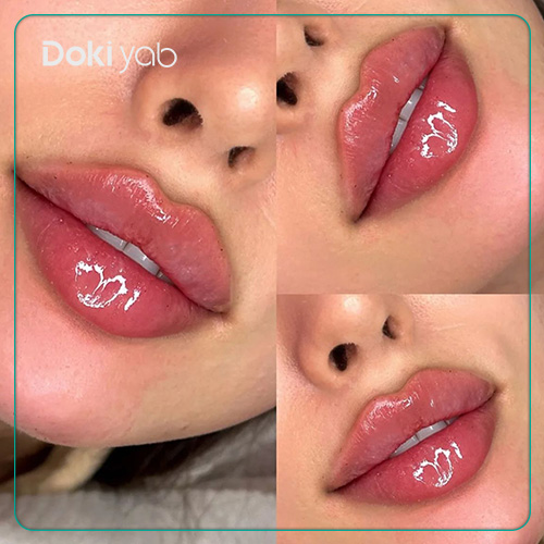 مراقبتهای لازم قبل از تزریق ژل لب قلوه ای