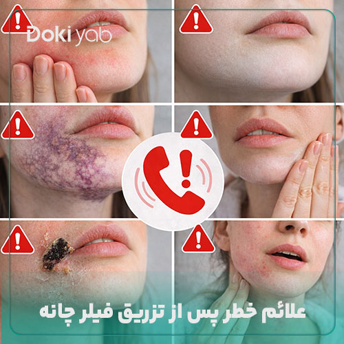 علائم خطر پس از تزریق فیلر چانه 