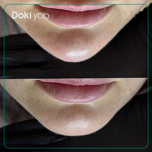 عکس نمونه‌کار تزریق ژل به چانه