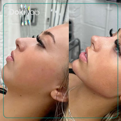 عکس نمونه تزریق فیلر چانه