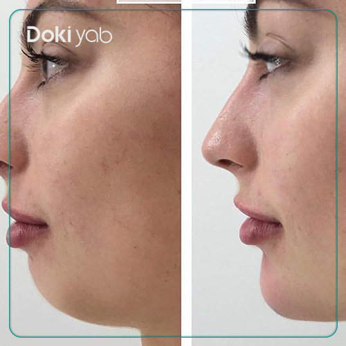 قبل و بعد تزریق فیلر چانه