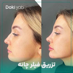 تزریق فیلر چانه