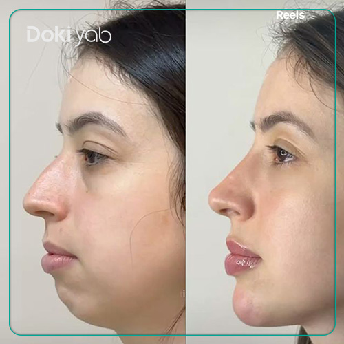 نمونه کار تزریق فیلر چانه