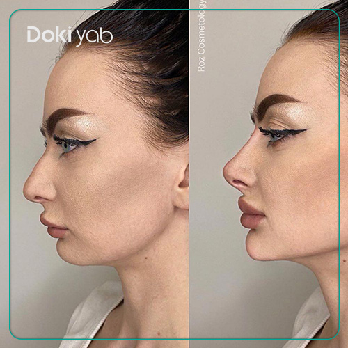 عکس نمونه تزریق ژل چانه