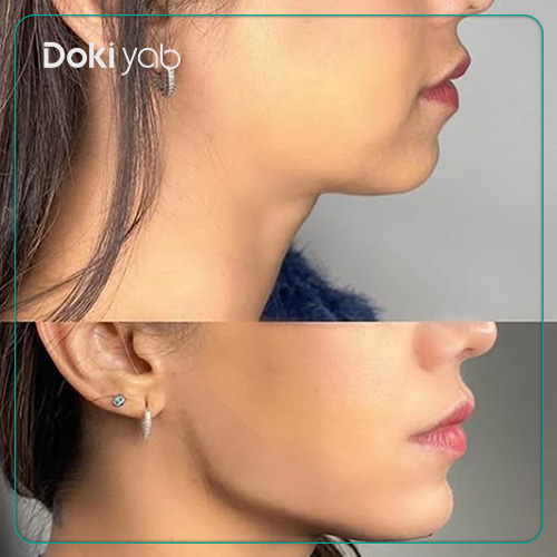 معرفی بهترین دکتر و کلینیک تزریق فیلر چانه در شیراز