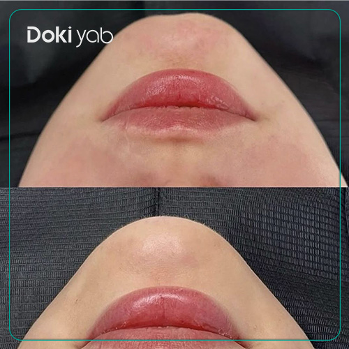 عکس تزریق ژل چانه