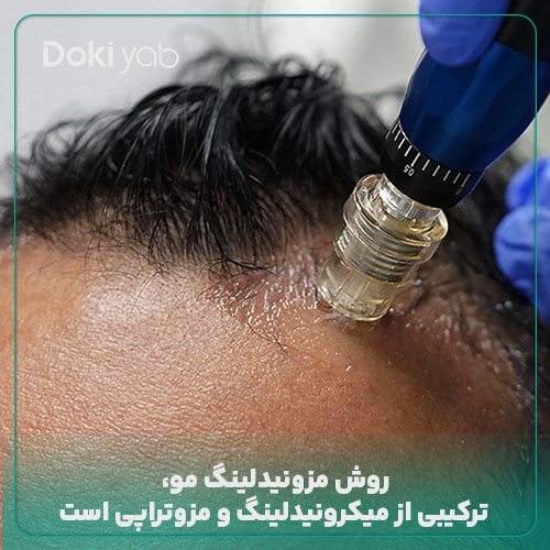 روش مزونیدلینگ مو؛ ترکیبی از میکرونیدلینگ و مزوتراپی