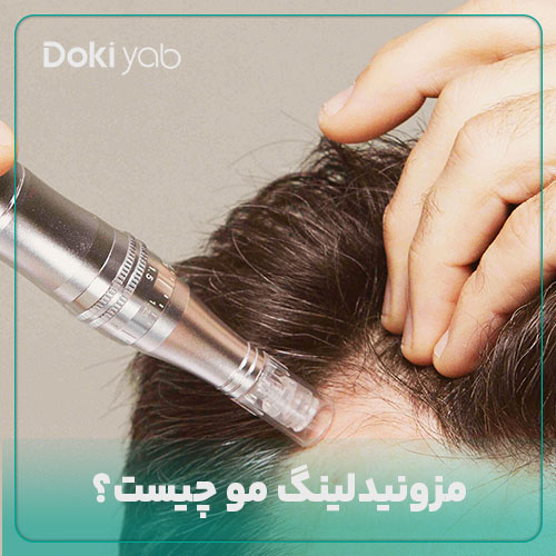 بررسی این‌که مزونیدلینگ مو چیست در دکی یاب