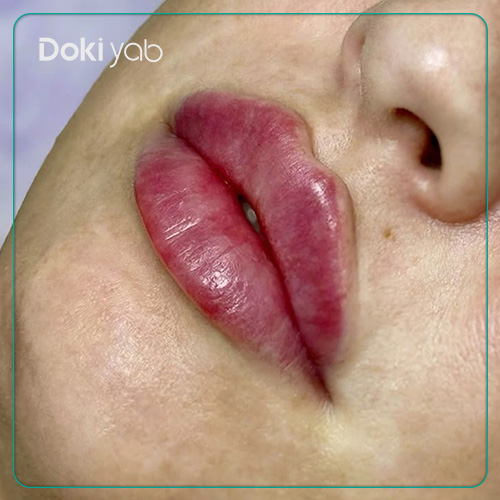 عکس تزریق ژل لب قلبی