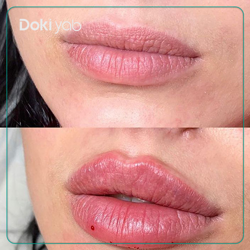 نمونه فیلر لب قلبی