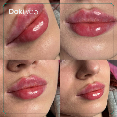 عکس تزریق ژل لب قلبی