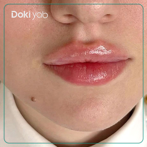 نمونه تزریق فیلر لب به سبک قلبی