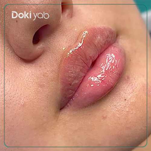 عکس تزریق ژل لب گرد