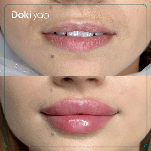 نحوه تزریق ژل لب گرد