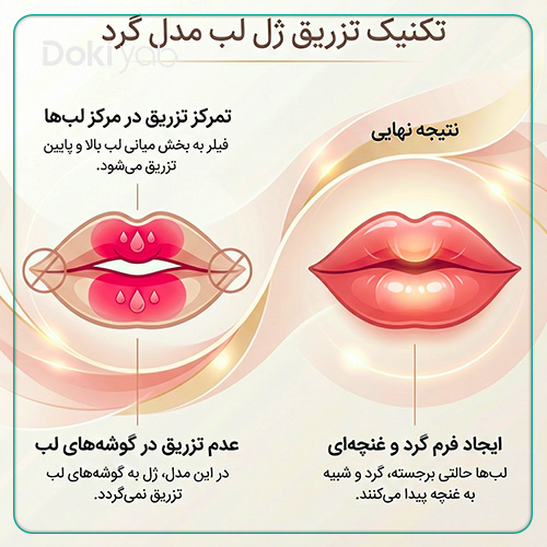 نحوه تزریق ژل لب گرد