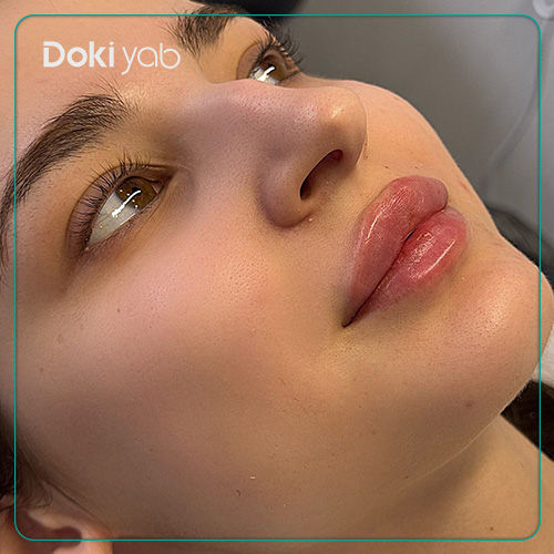 عکس نمونه‌کار تزریق لب فرم گرد