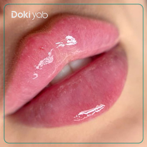 نمونه تزریق فیلر لب گرد