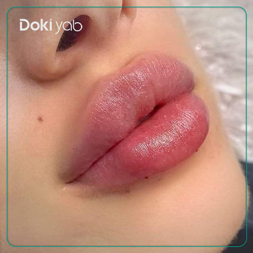 هزینه تزریق ژل لب گرد