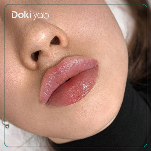 مراقبت‌های بعد از تزریق ژل لب گرد