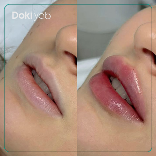 ماندگاری ژل لب گرد؛ عکس ژل لب مدل گرد با دکی یاب