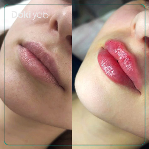 عکس تزریق ژل لب سه‌دکمه‌ای 