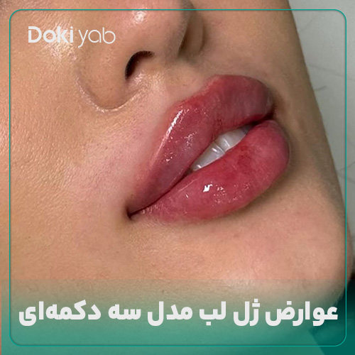 عوارض تزریق ژل لب سه دکمه‌ای