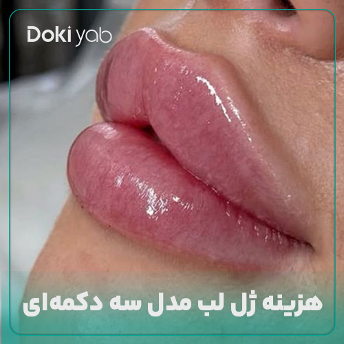 هزینه ژل لب مدل سه دکمه‌ای