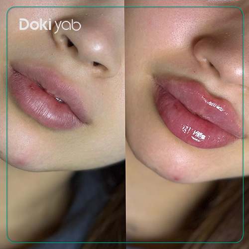 نمونه فیلر لب سه‌دکمه‌ای 