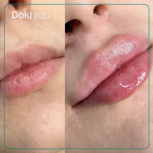 عکس نمونه تزریق فیلر لب مدل سه دکمه‌ای