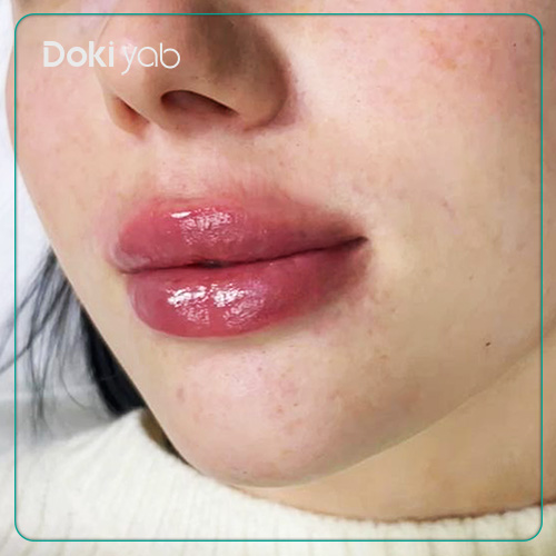 تزریق فیلر لب سه‌دکمه‌ای