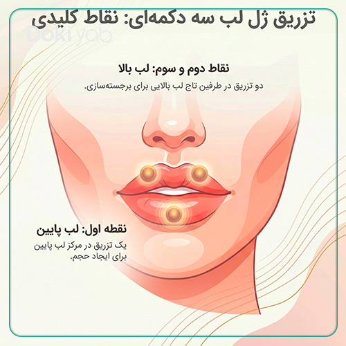 ژل لب سه دکمه‌ای؛ تزریق ژل به سه بخش اصلی در لب