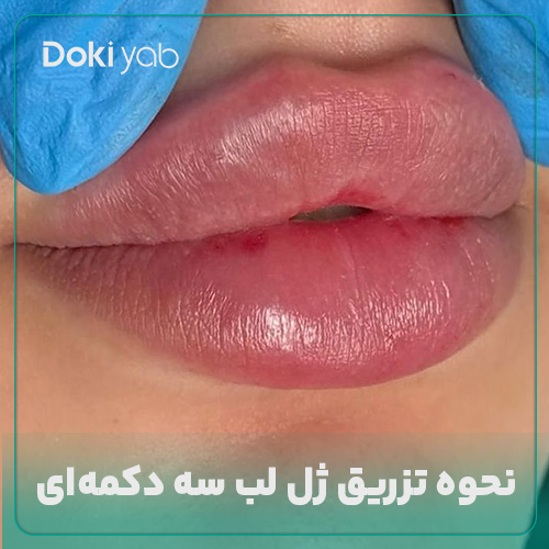 بررسی نحوه تزریق ژل لب سه دکمه‌ای