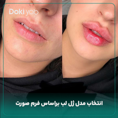 انتخاب مدل ژل لب براساس فرم صورت