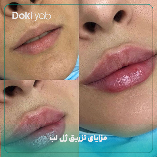 بررسی مزایای تزریق ژل لب