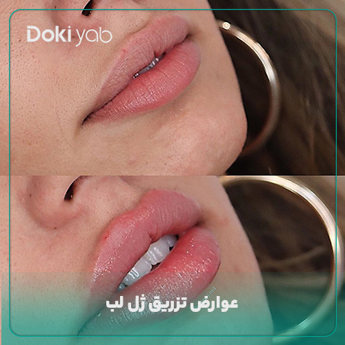بررسی عوارض تزریق ژل لب