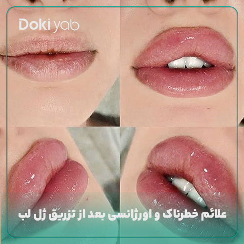 علائم خطرناک بعد از تزریق ژل لب