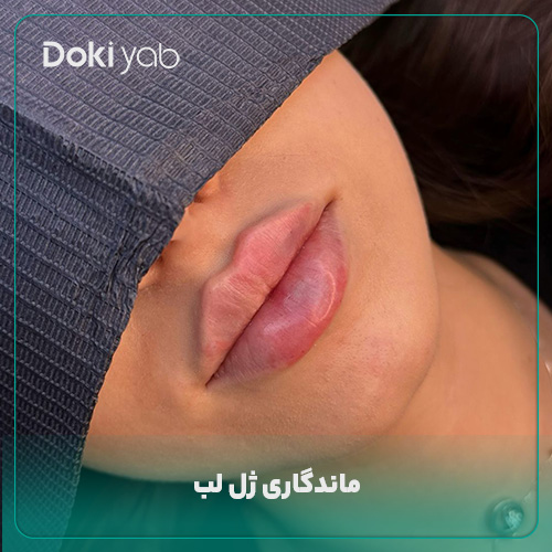 بررسی ماندگاری ژل لب