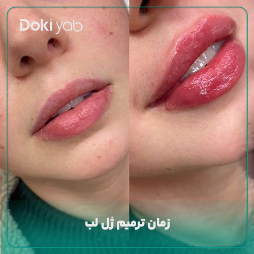 زمان ترمیم ژل لب