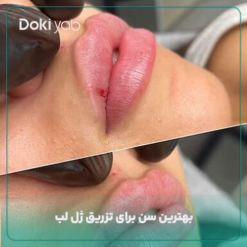 بهترین سن برای تزریق ژل لب