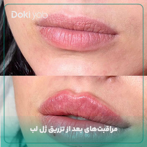 مراقبت‌های بعد از تزریق ژل لب